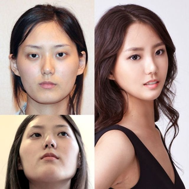 Plastic Surgery in Korea! 10 Pics!