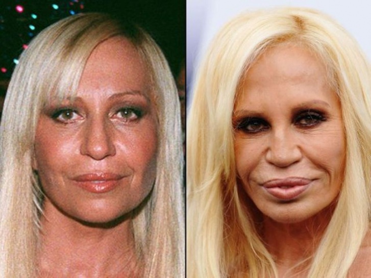 10 Famous But Worst Examples of Plastic Surgery Ever!